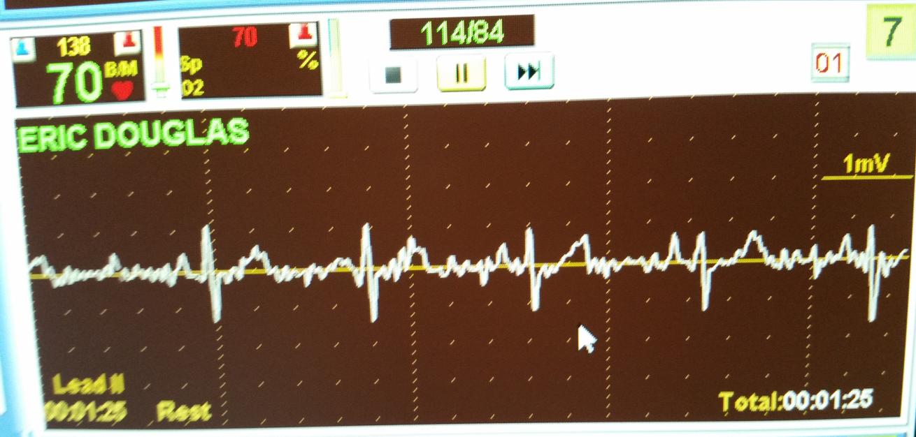 Heart Monitor During Cardiac Rehab