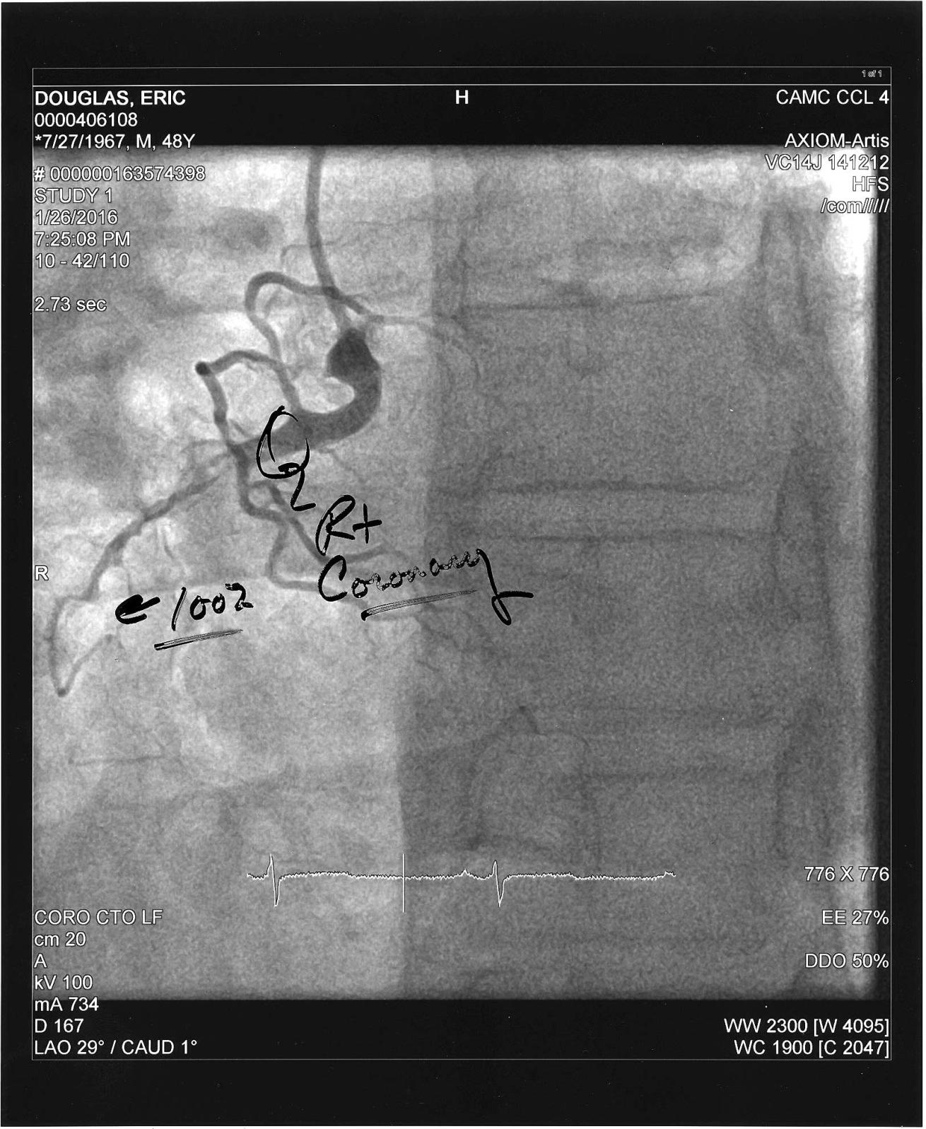 Clogged Artery Heart Attack catheterization