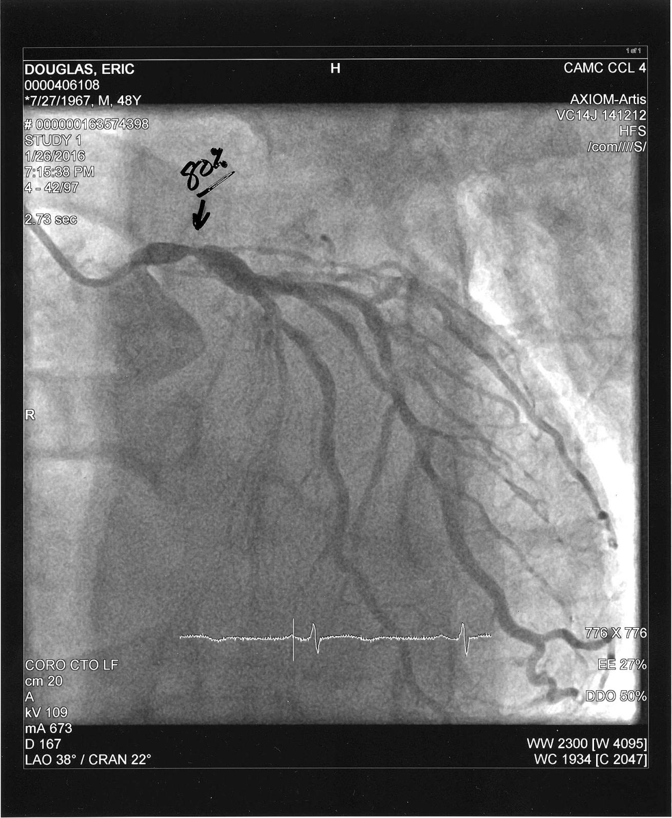 X Ray Heart Attack Clogged Arteries catheterization