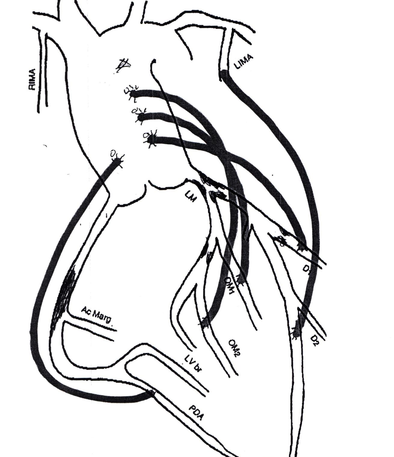 Heart Surgery Diagram