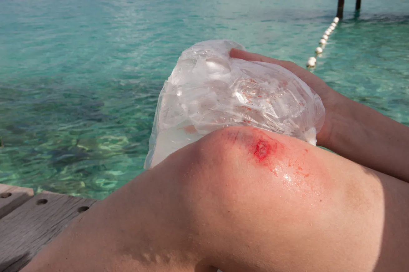 A person holding a plastic bag of ice over a wounded knee
