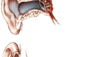 TR_end_ear_pain.gif.webp